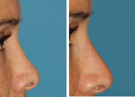 icon for Liquid Rhinoplasty