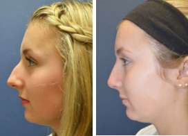 icon for Rhinoplasty