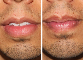 icon for Lip Reduction