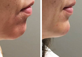 icon for Non-Surgical Chin Augmentation