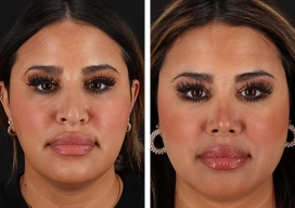 icon for Facial Liposuction