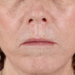 Lip Lift Before & After Patient #2155