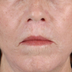 Lip Lift Before & After Patient #2155