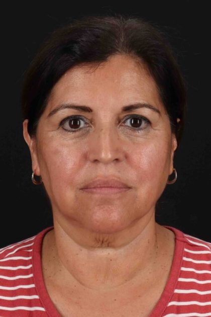Facelift Before & After Patient #3544