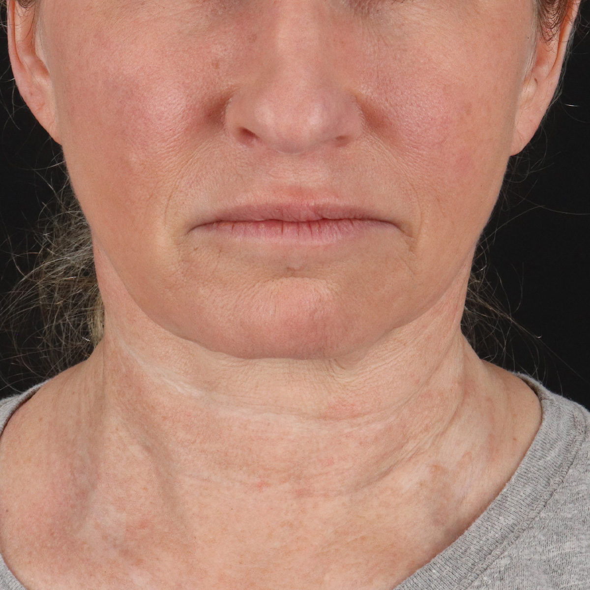 Neck Lift Before & After Patient #2571