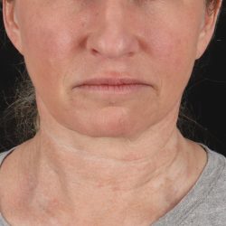 Facelift Before & After Patient #1866