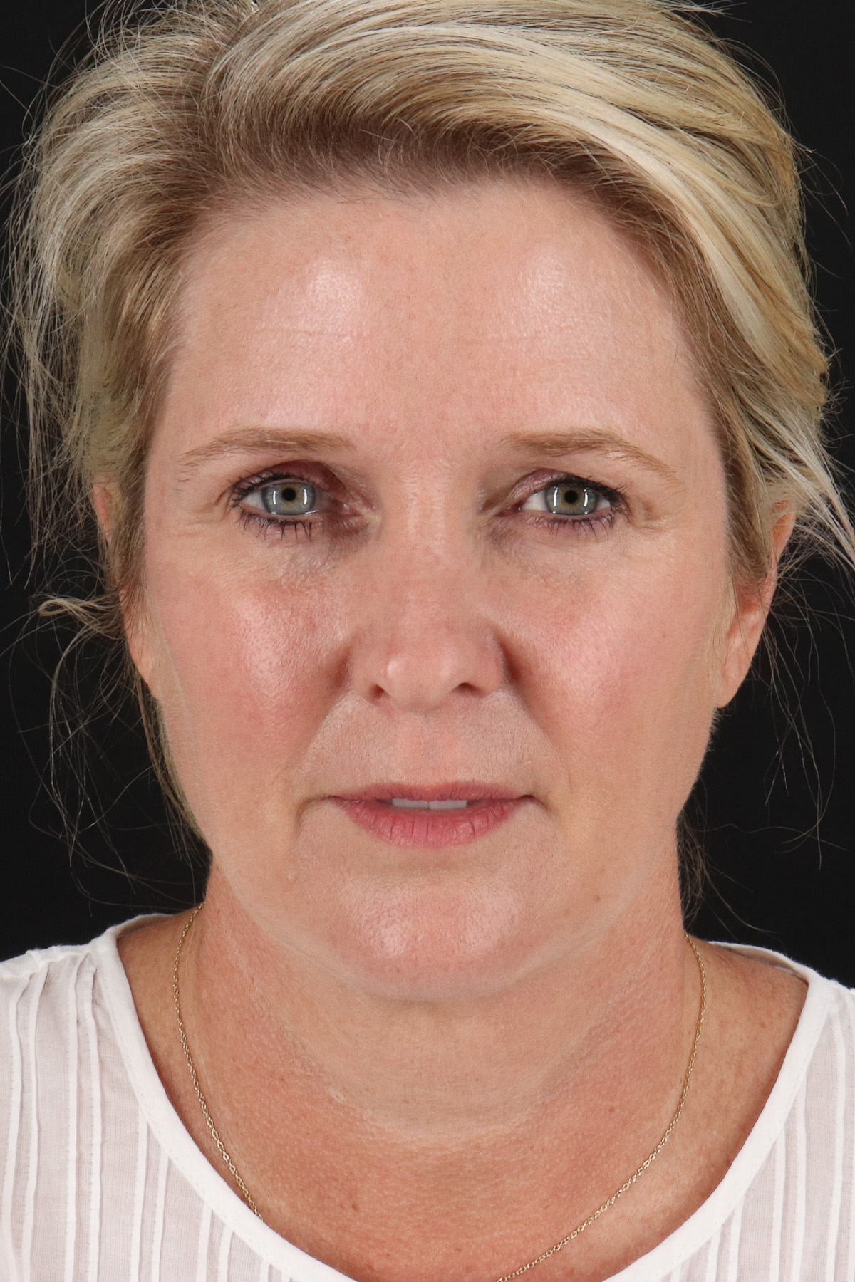 Neck Lift Before & After Patient #2582