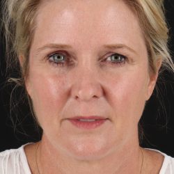 Facelift Before & After Patient #1877