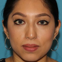 Chin Implant Before & After Patient #1670