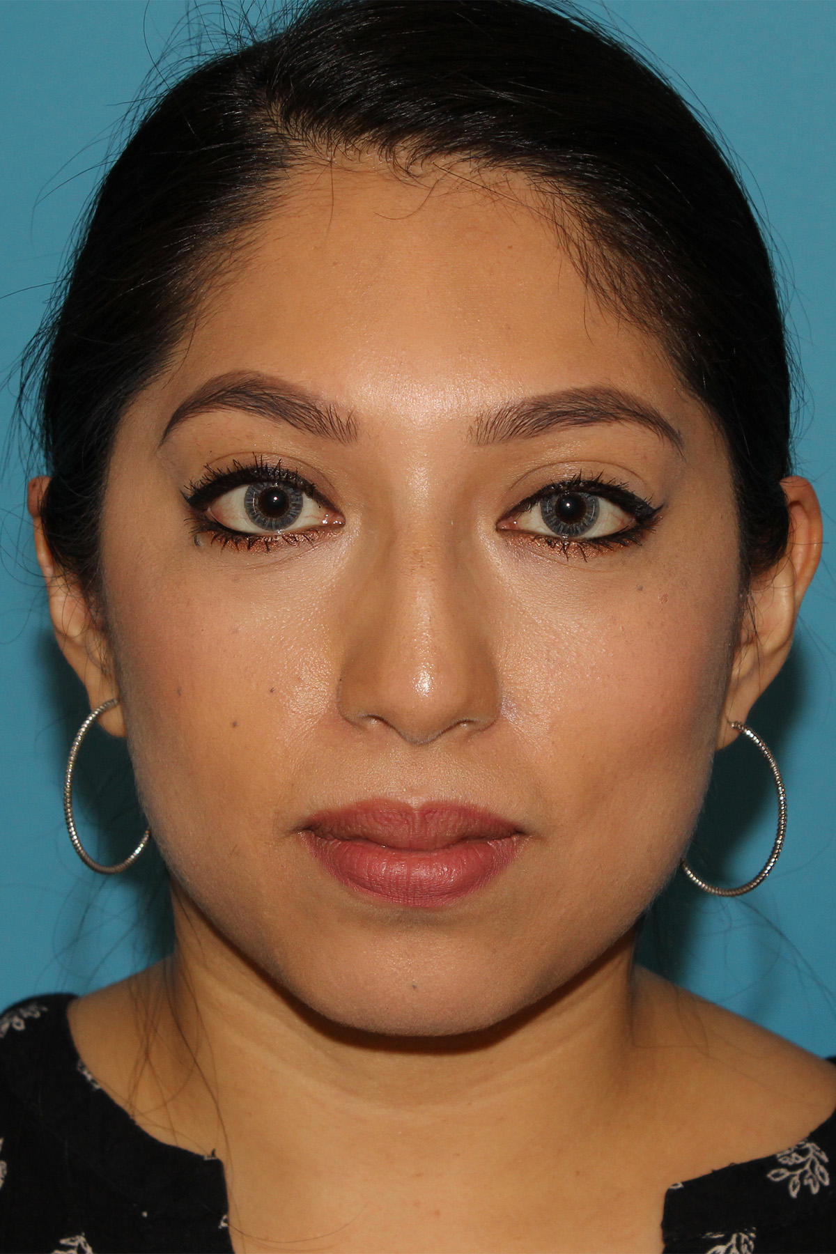 Chin Implant Before & After Patient #1670