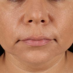 Facelift Before & After Patient #3555