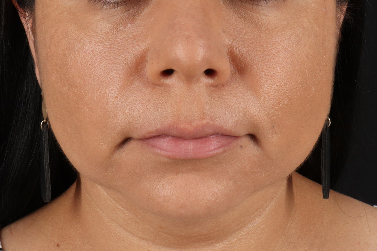 Facelift Before & After Patient #3555