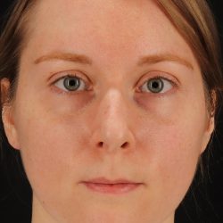 Rhinoplasty Before & After Patient #3280