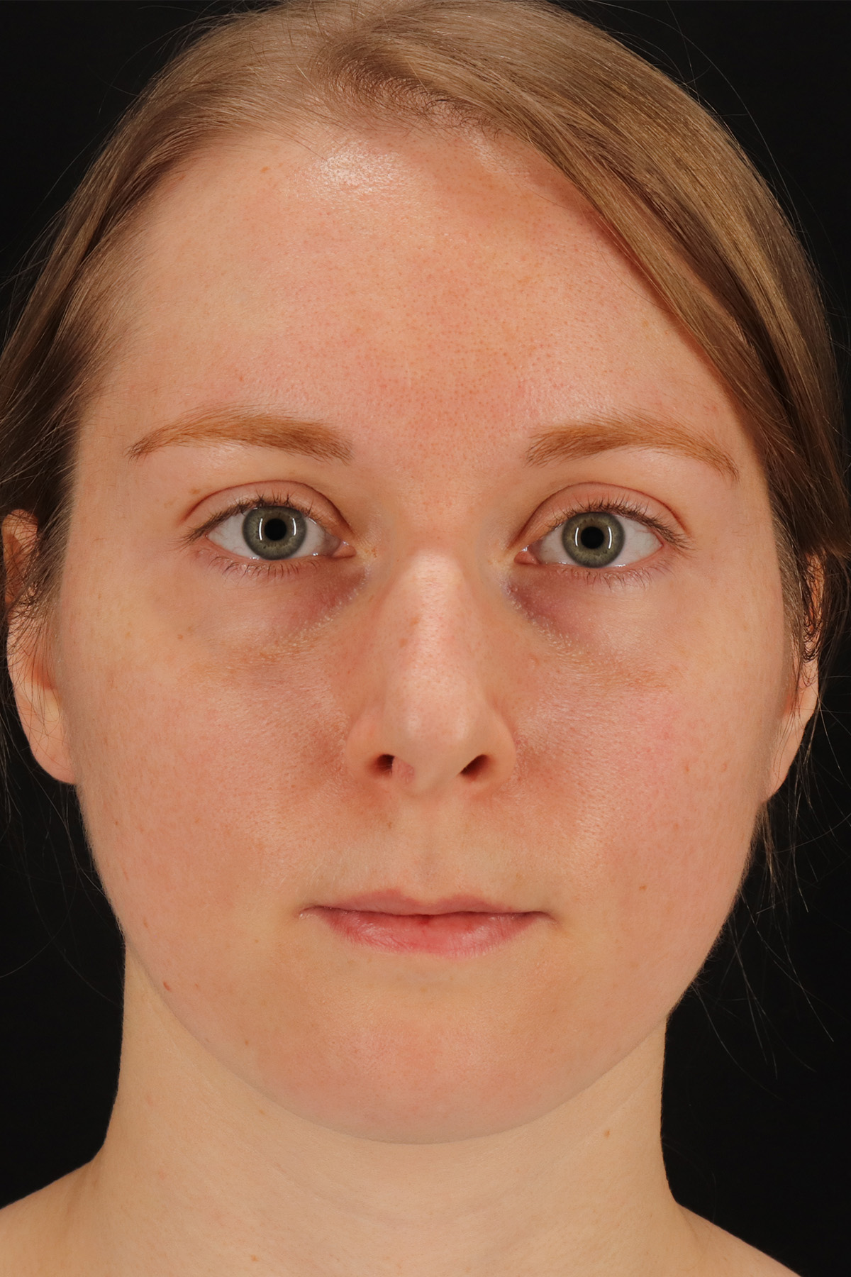 Rhinoplasty Before & After Patient #3280