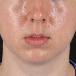 Chin Implant Before & After Patient #1562