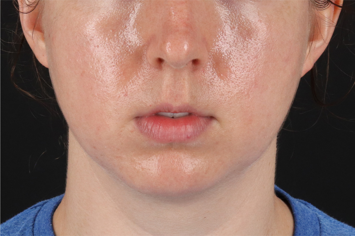 Chin Implant Before & After Patient #1562