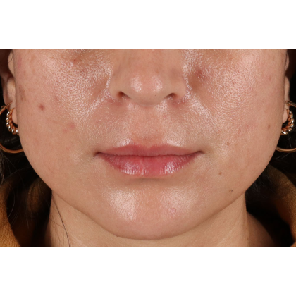 Lip Lift Before & After Patient #2166