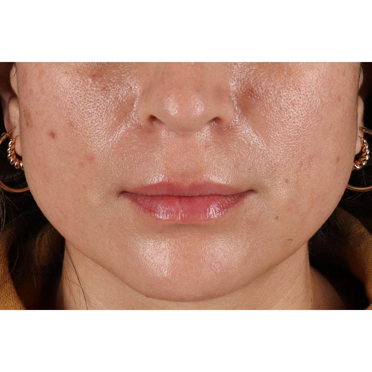 Lip Lift Before & After Patient #2166