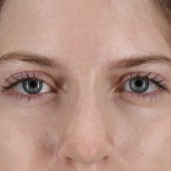 Browlift Before & After Patient #1319