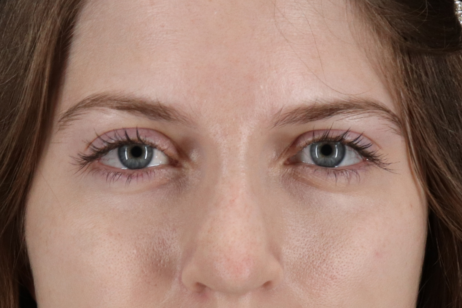 Browlift Before & After Patient #1319