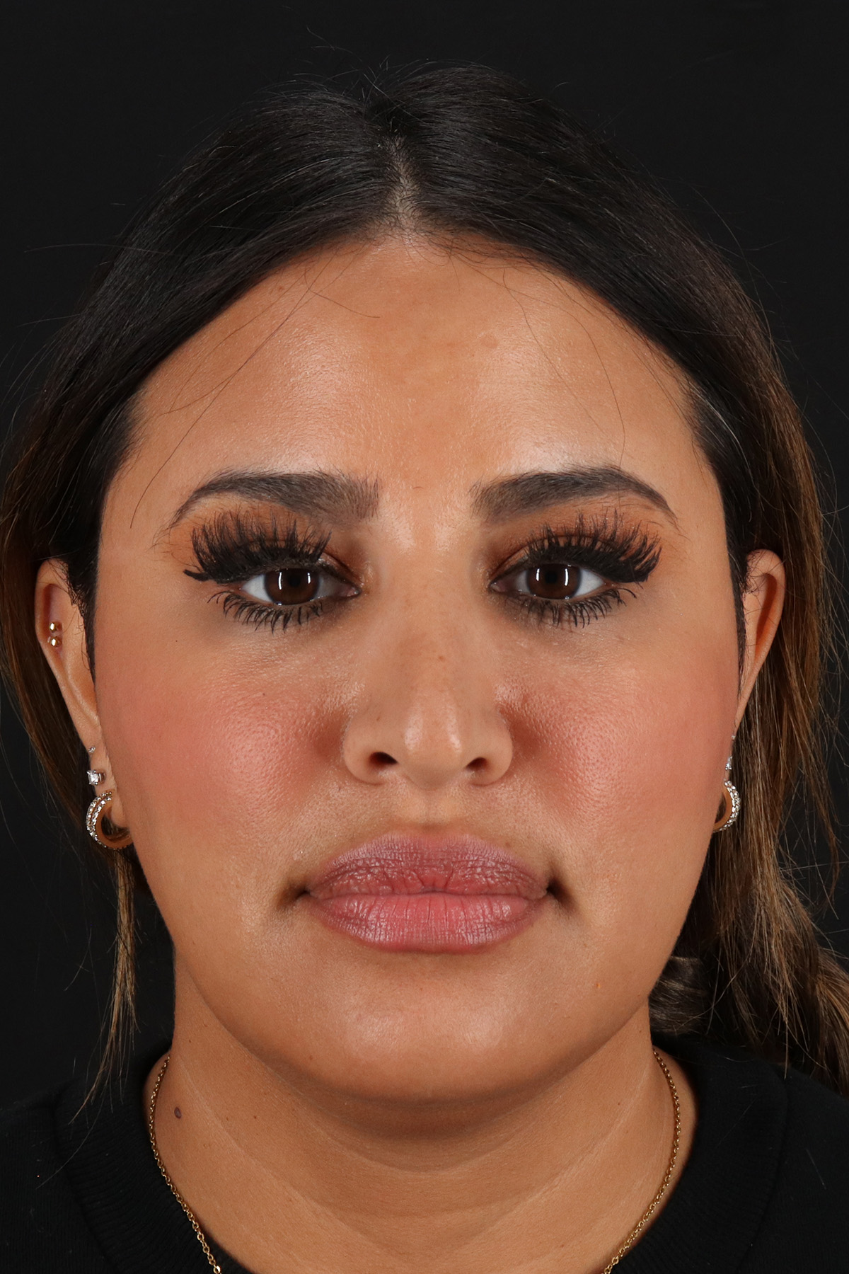 Neck Liposuction Before & After Patient #2708