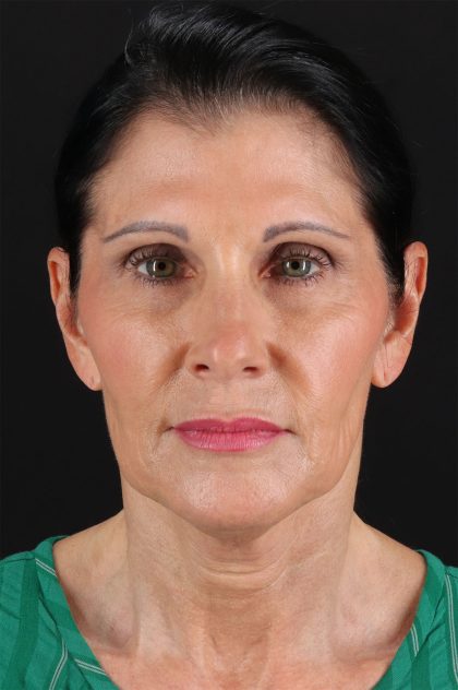 Fat Grafting To The Face Before & After Patient #2005