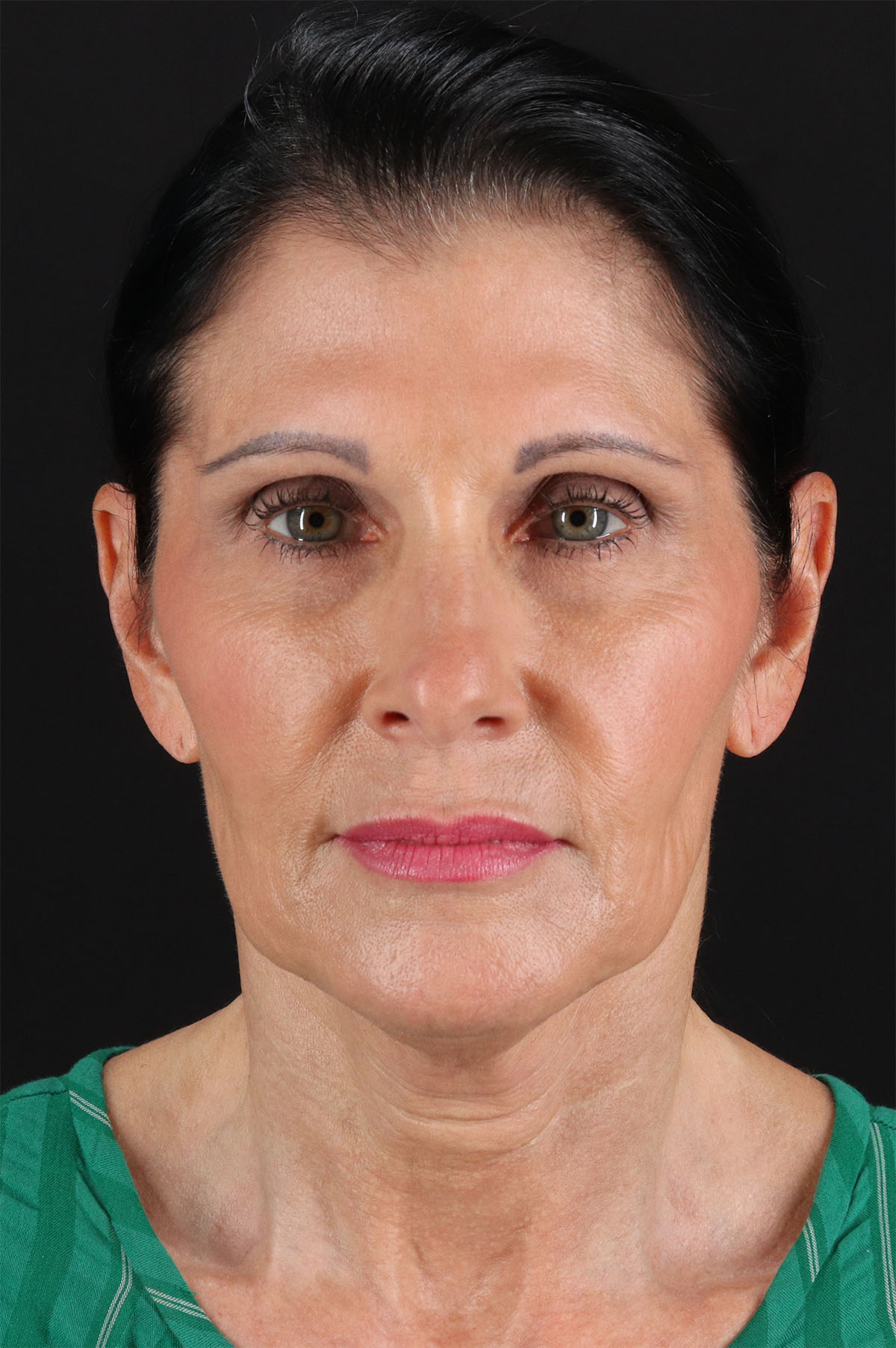 Fat Grafting To The Face Before & After Patient #2005