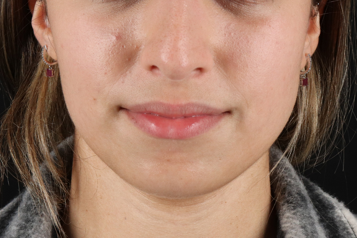 Chin Implant Before & After Patient #1573
