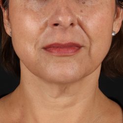 Neck Lift Before & After Patient #2472