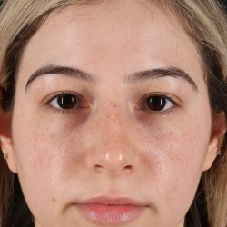 Rhinoplasty Before & After Patient #3247