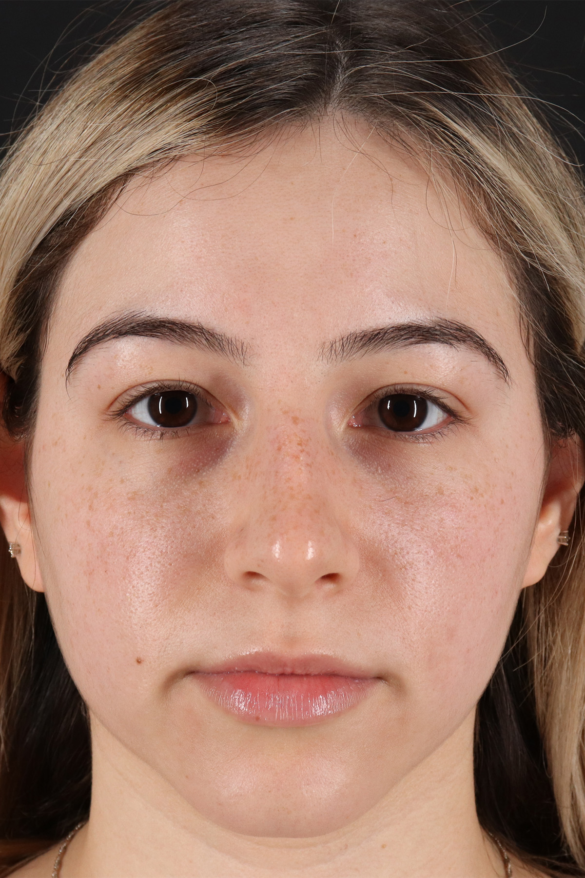 Rhinoplasty Before & After Patient #3247
