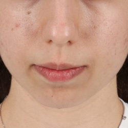 Chin Implant Before & After Patient #1551