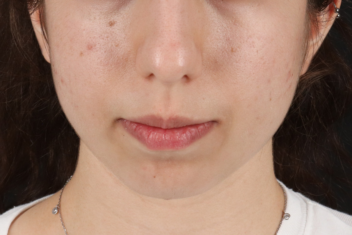 Chin Implant Before & After Patient #1551