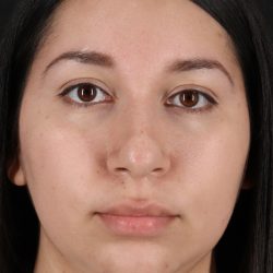 Chin Implant Before & After Patient #1604