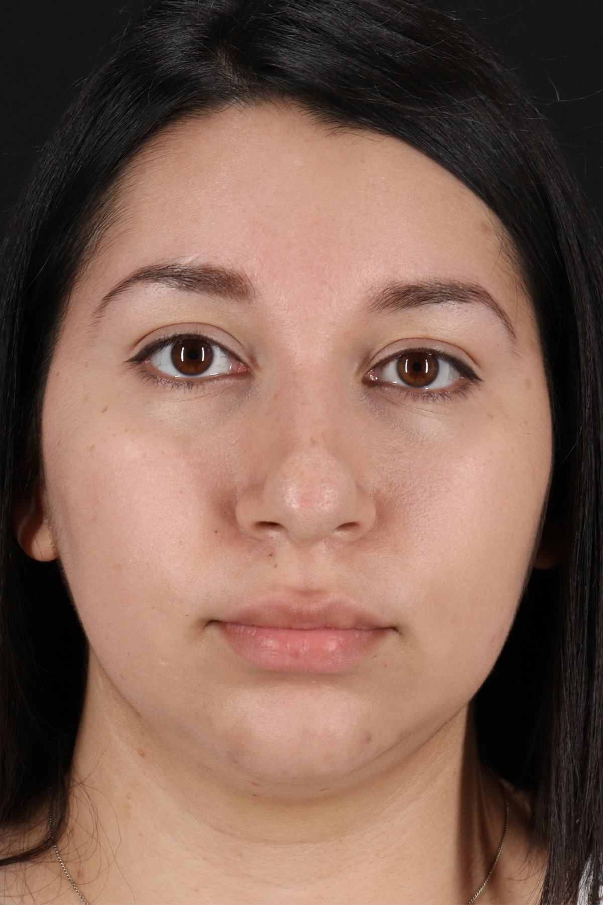 Chin Implant Before & After Patient #1604