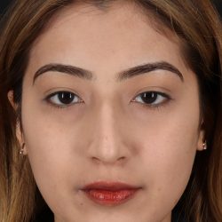 Liquid Rhinoplasty Before & After Patient #2254