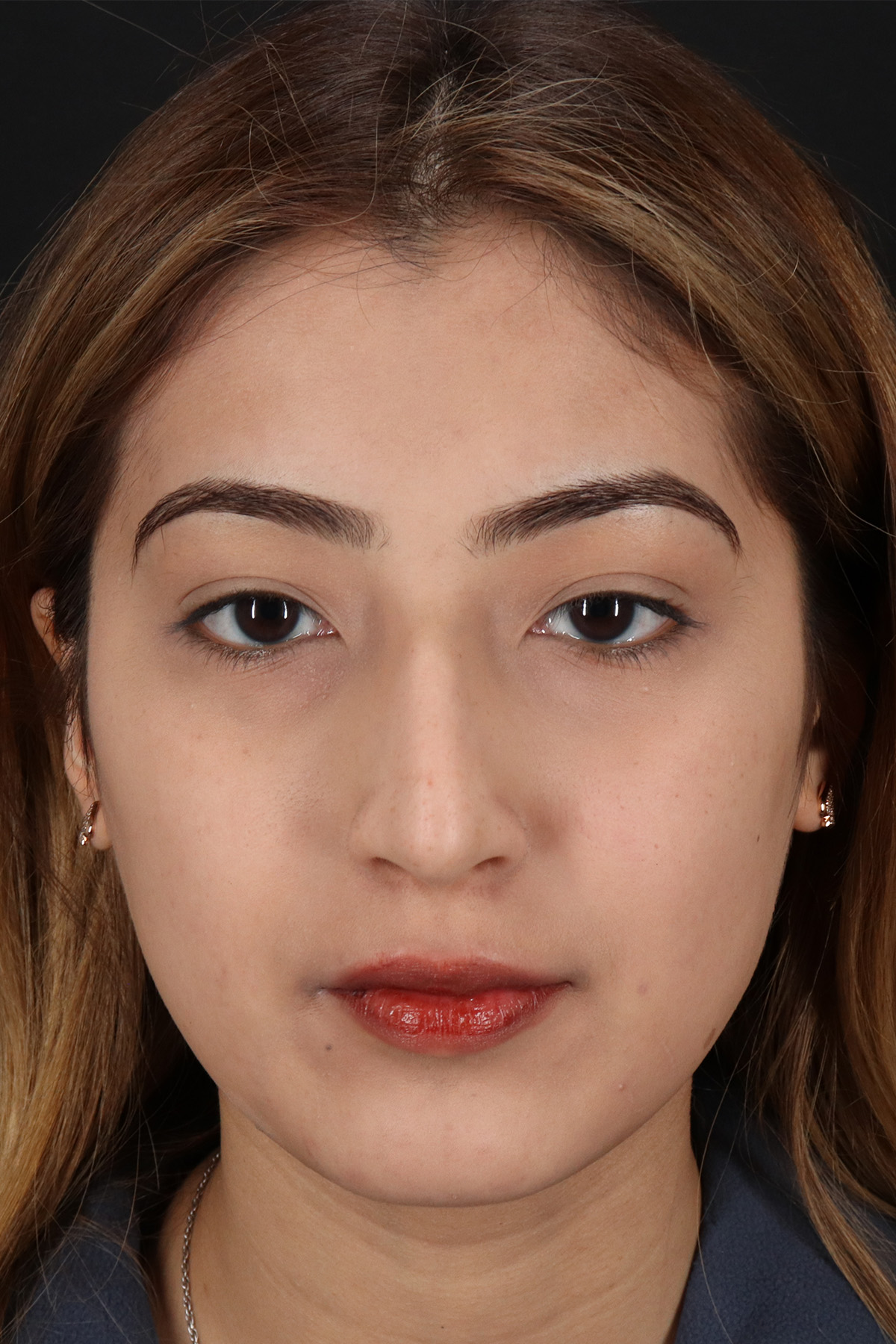 Liquid Rhinoplasty Before & After Patient #2254