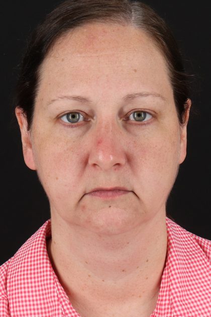 Facelift Before & After Patient #1843