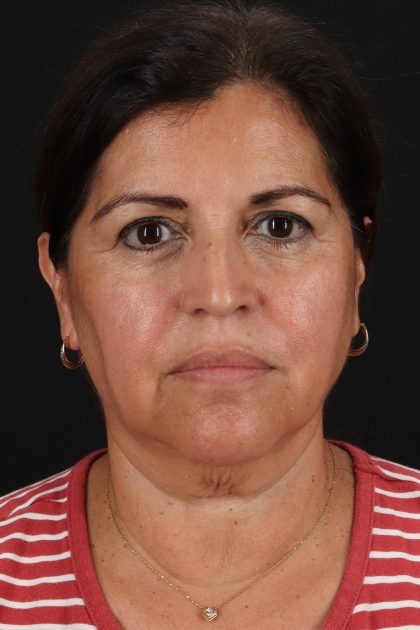 Facelift Before & After Patient #3544