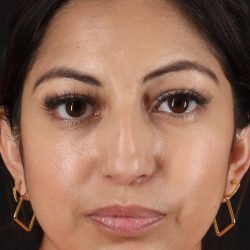 Rhinoplasty Before & After Patient #3049