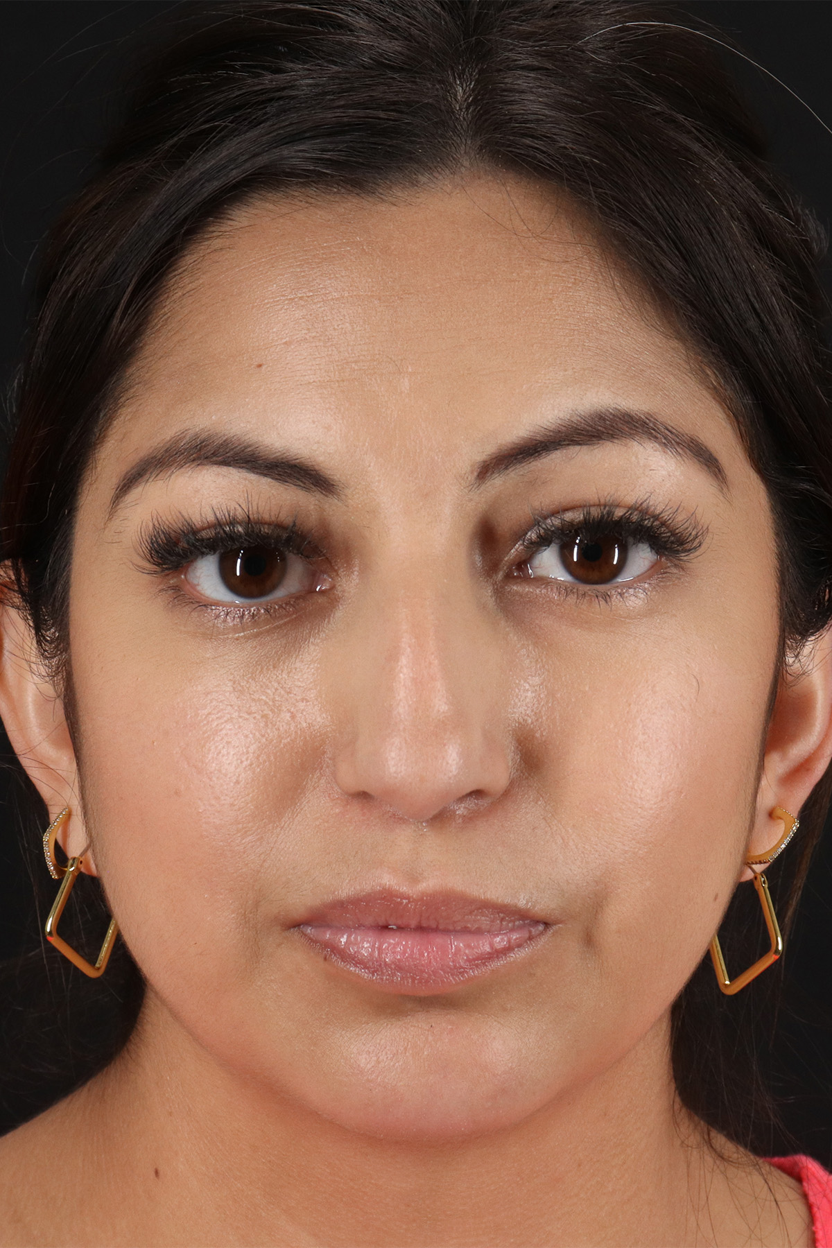 Rhinoplasty Before & After Patient #3049