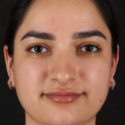 Rhinoplasty Before & After Patient #3071