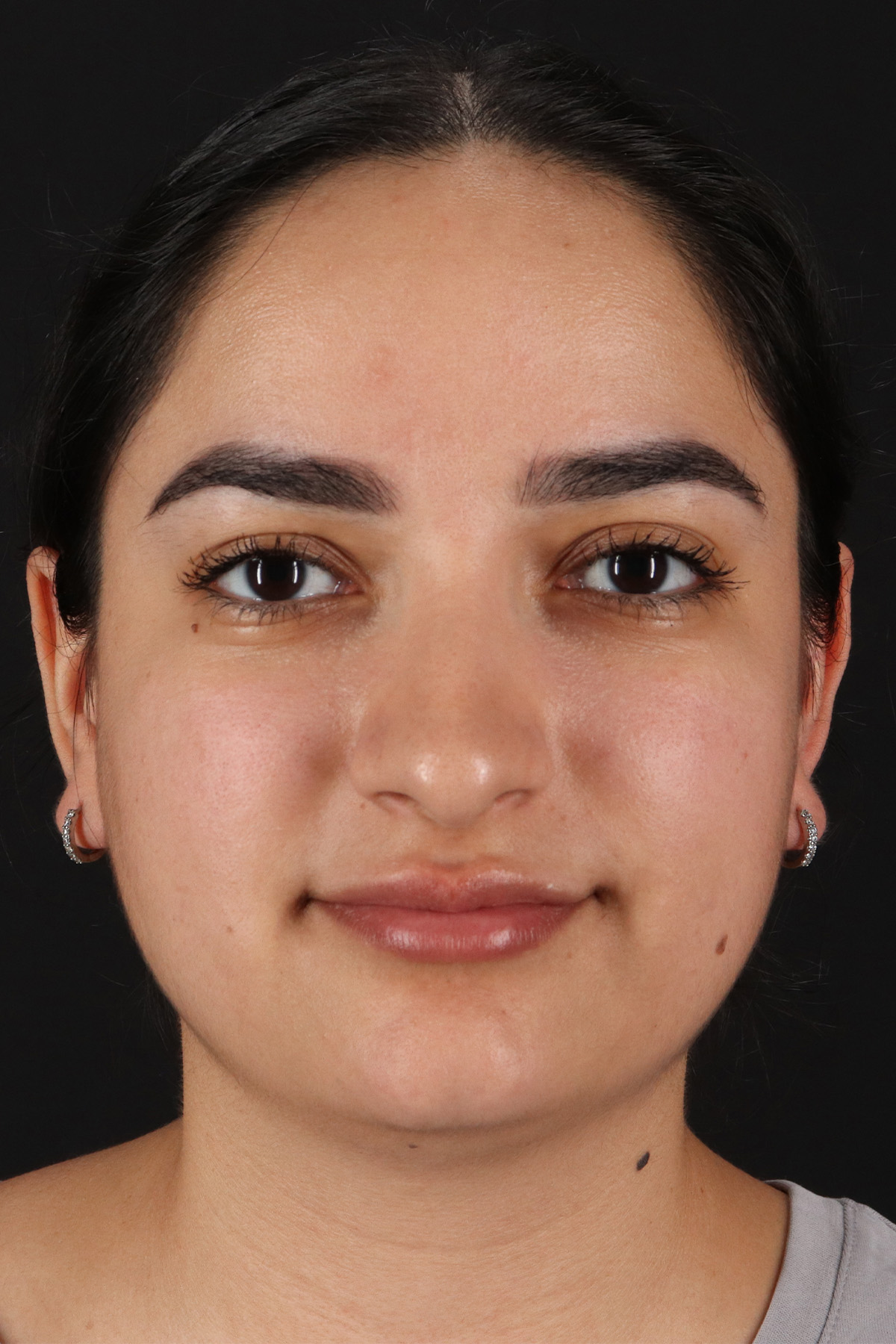Rhinoplasty Before & After Patient #3071
