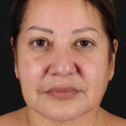 Neck Lift Before & After Patient #2593
