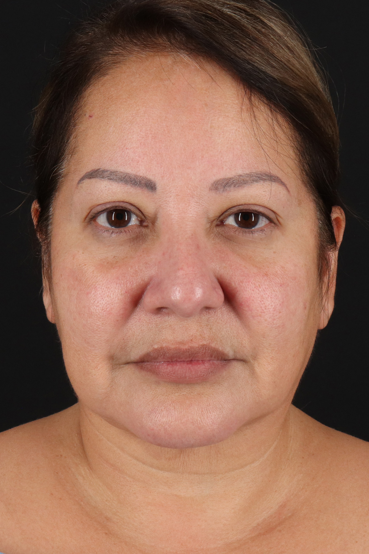 Neck Lift Before & After Patient #2593