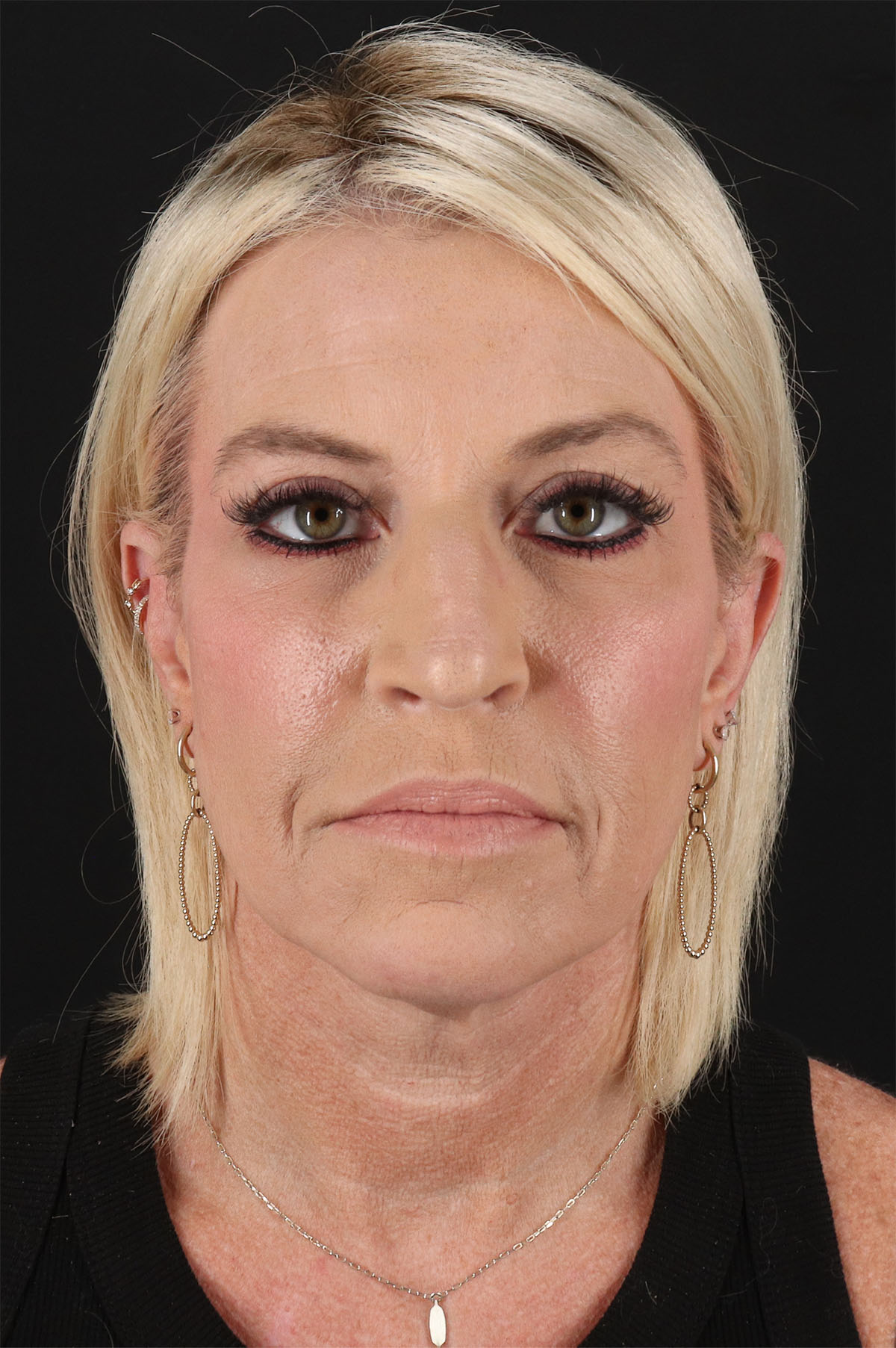 Rhinoplasty Before & After Patient #2796