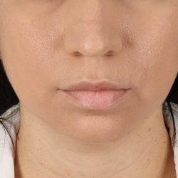 Chin Implant Before & After Patient #1540