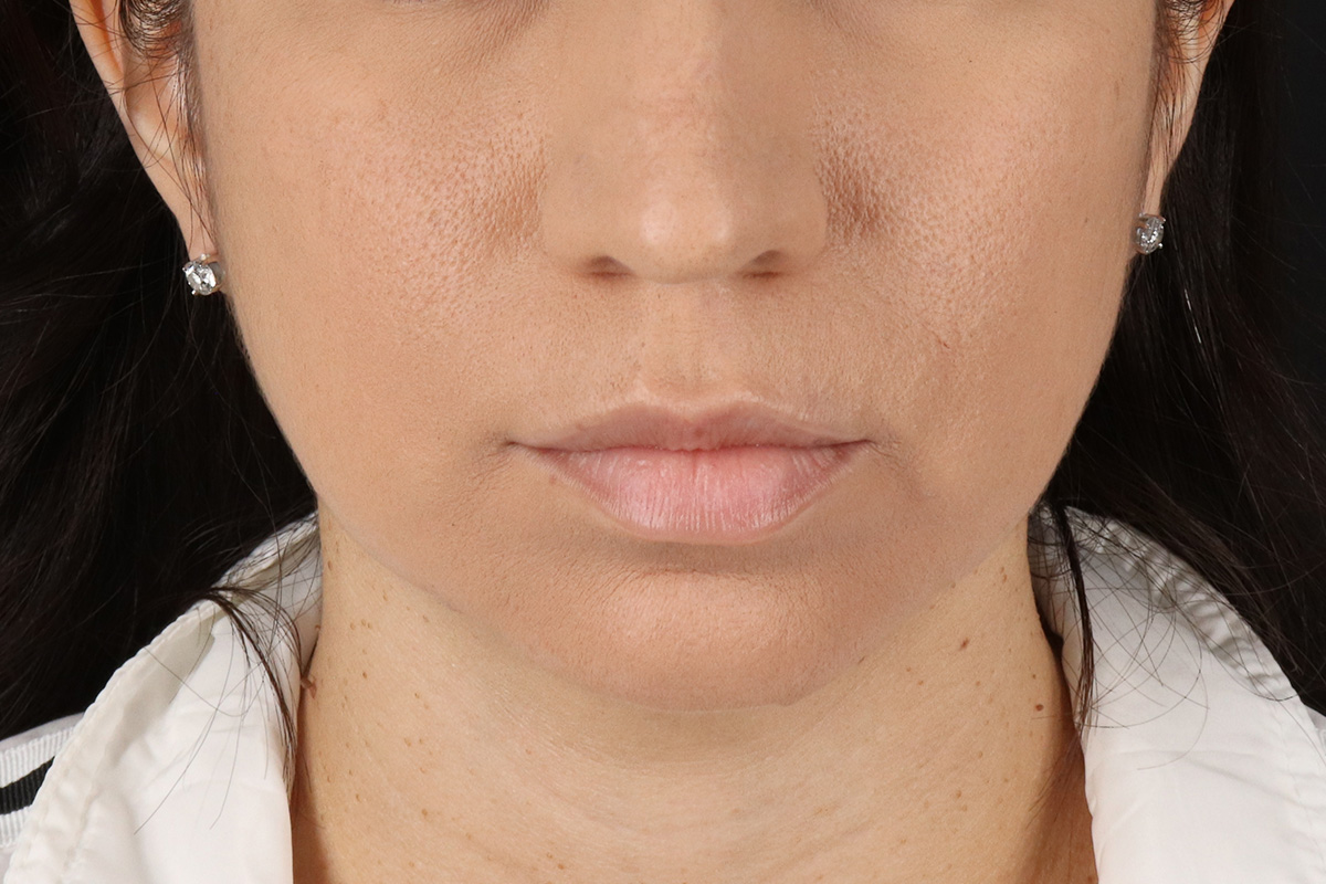 Chin Implant Before & After Patient #1540