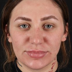 Rhinoplasty Before & After Patient #3104