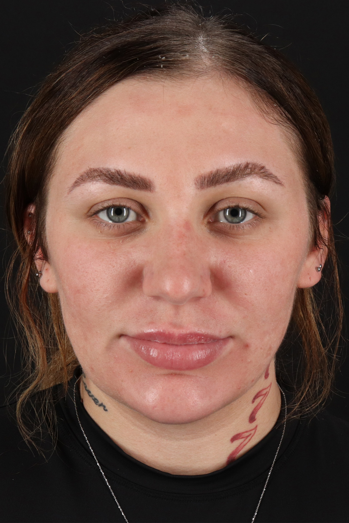 Rhinoplasty Before & After Patient #3104